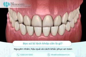 Bọc sứ bị lệch khớp cắn là gì? Nguyên nhân, hậu quả và cách khắc phục an toàn