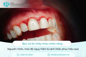 Bọc sứ bị chảy máu chân răng: Nguyên nhân, mức độ nguy hiểm & cách khắc phục hiệu quả