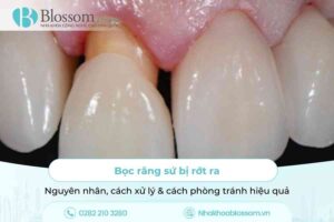 Bọc răng sứ bị rớt ra: Nguyên nhân, cách xử lý & cách phòng tránh hiệu quả