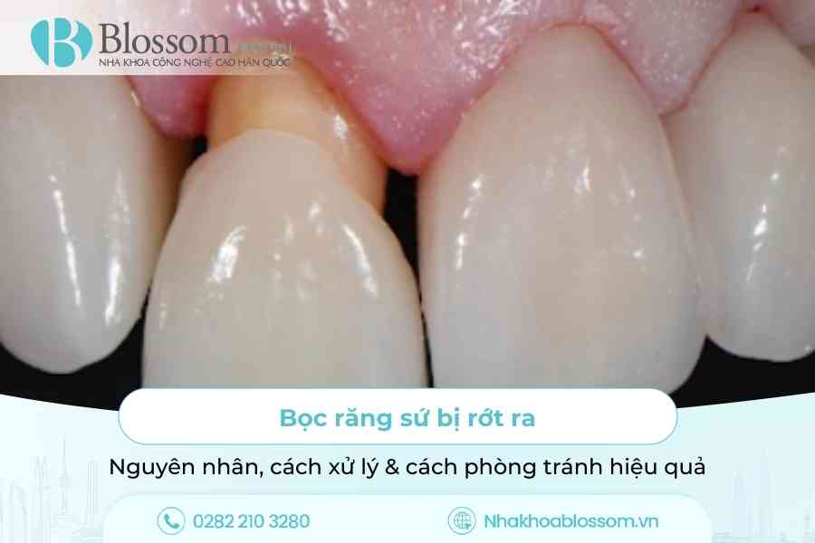 Bọc răng sứ bị rớt ra: Nguyên nhân, cách xử lý & cách phòng tránh hiệu quả