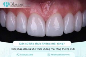 Dán sứ khe thưa không mài răng? Giải pháp dán sứ khe thưa không mài răng thế hệ mới