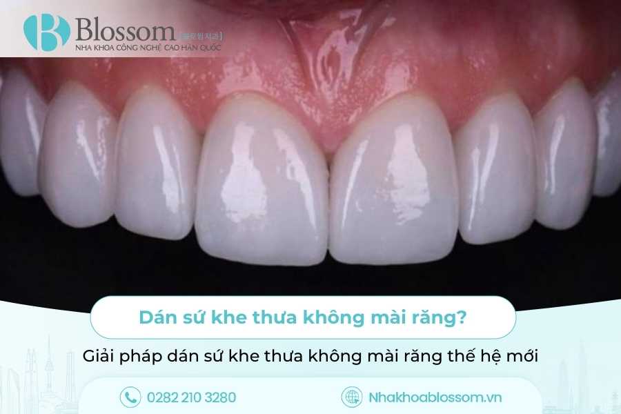 Dán sứ khe thưa không mài răng? Giải pháp dán sứ khe thưa không mài răng thế hệ mới