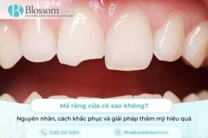 Mẻ răng cửa có sao không? Nguyên nhân, cách khắc phục và giải pháp thẩm mỹ hiệu quả
