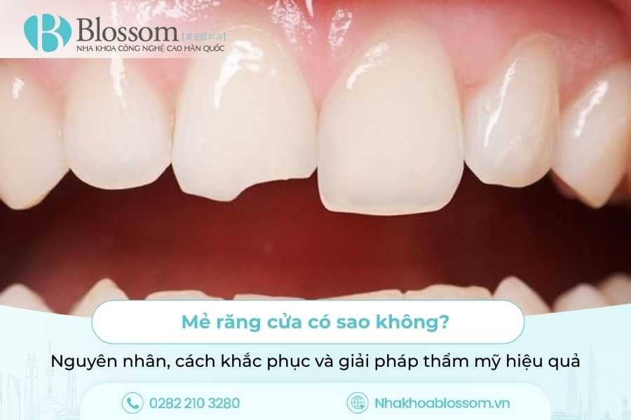 Mẻ răng cửa có sao không? Nguyên nhân, cách khắc phục và giải pháp thẩm mỹ hiệu quả