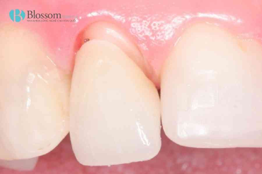 boc rang su bi rot ra 1