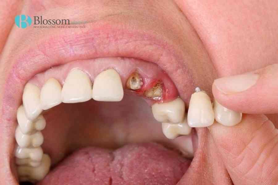 boc rang su bi rot ra 2