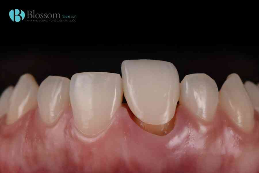 boc rang su bi rot ra 3