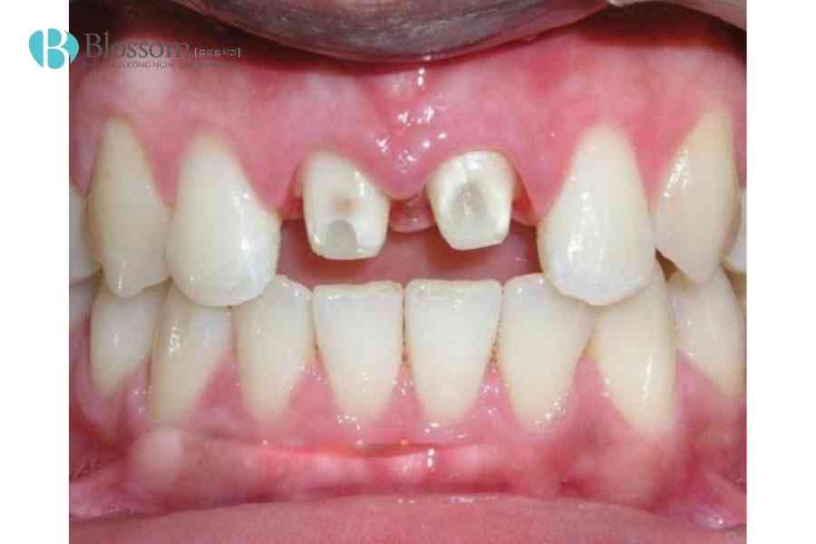 boc rang su bi rot ra 4