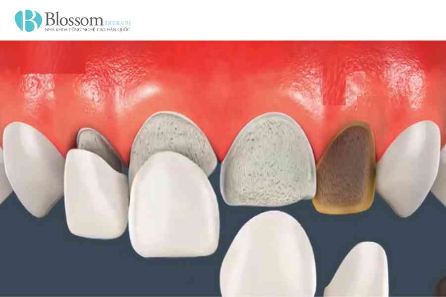 boc rang su bi rot ra 5