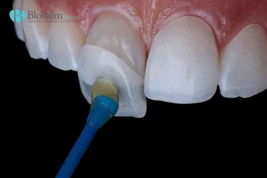 boc rang su bi rot ra 6