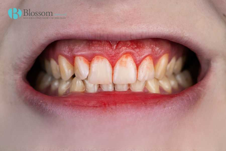 Bọc sứ bị chảy máu chân răng: Nguyên nhân, mức độ nguy hiểm & cách khắc phục hiệu quả 1 boc su bi chay mau chan rang 1