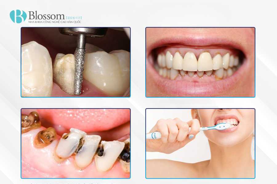 Bọc sứ bị chảy máu chân răng: Nguyên nhân, mức độ nguy hiểm & cách khắc phục hiệu quả 2 boc su bi chay mau chan rang 2