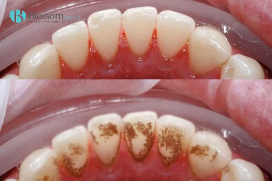 Bọc sứ bị chảy máu chân răng: Nguyên nhân, mức độ nguy hiểm & cách khắc phục hiệu quả 3 boc su bi chay mau chan rang 3