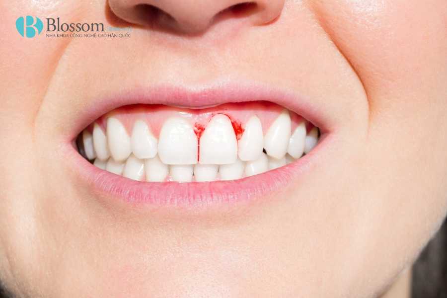 Bọc sứ bị chảy máu chân răng: Nguyên nhân, mức độ nguy hiểm & cách khắc phục hiệu quả 4 boc su bi chay mau chan rang 4