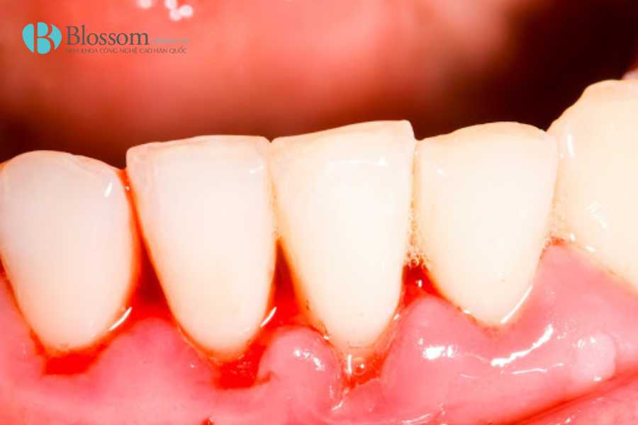 Bọc sứ bị chảy máu chân răng: Nguyên nhân, mức độ nguy hiểm & cách khắc phục hiệu quả 5 boc su bi chay mau chan rang 5