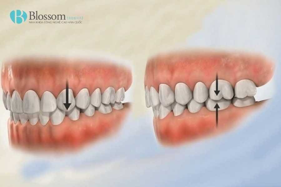 boc su bi lech khop can 1 1