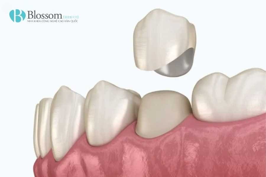 boc su bi lech khop can 3 1