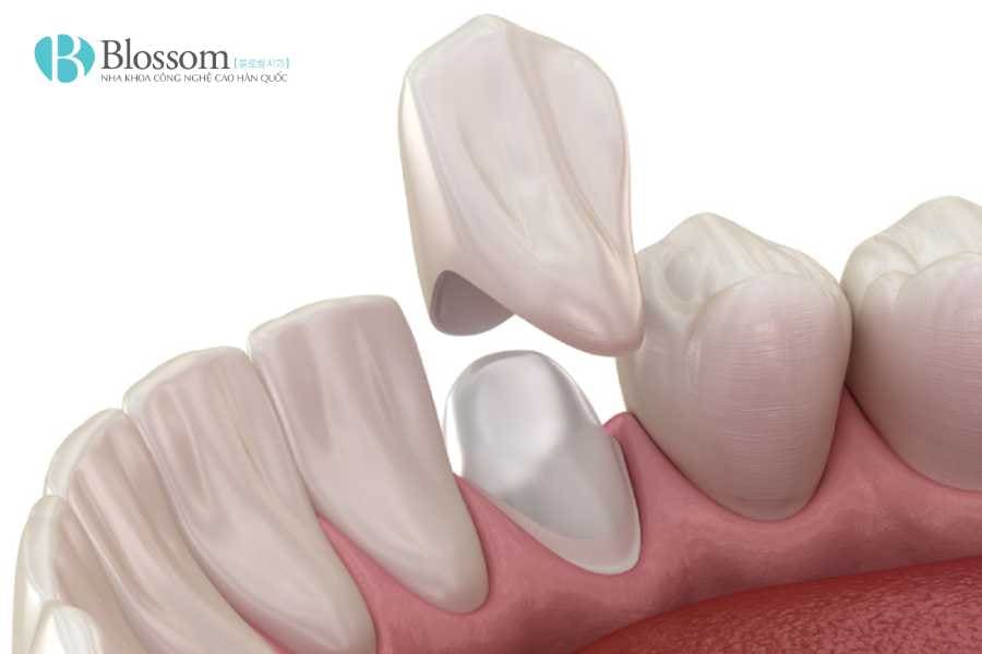 boc su bi lech khop can 5 1