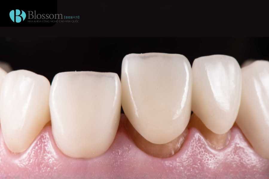 boc su bi lech khop can 6 1