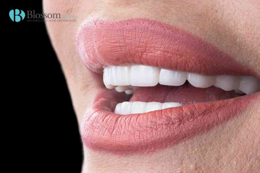 Bọc sứ có bền không? Răng sứ dùng được bao lâu và có vĩnh viễn không? 1 boc su co ben khong 1