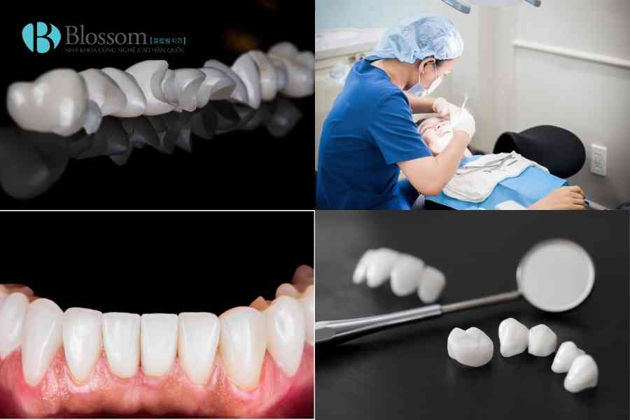 Bọc sứ có bền không? Răng sứ dùng được bao lâu và có vĩnh viễn không? 5 boc su co ben khong 5