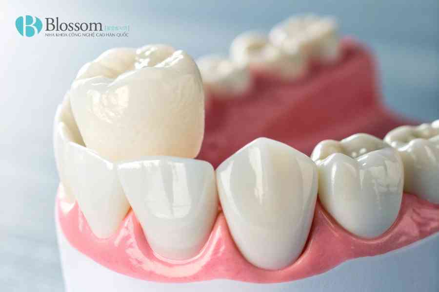 Bọc sứ có bền không? Răng sứ dùng được bao lâu và có vĩnh viễn không? 8 boc su co ben khong 8