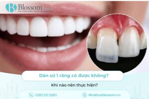Dán sứ 1 răng có được không? Khi nào nên thực hiện?