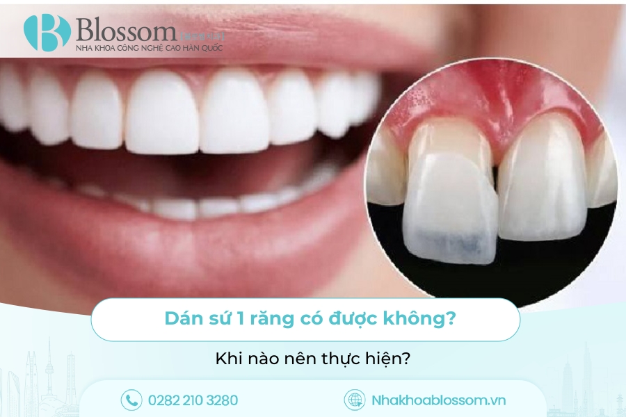 Dán sứ 1 răng có được không? Khi nào nên thực hiện?