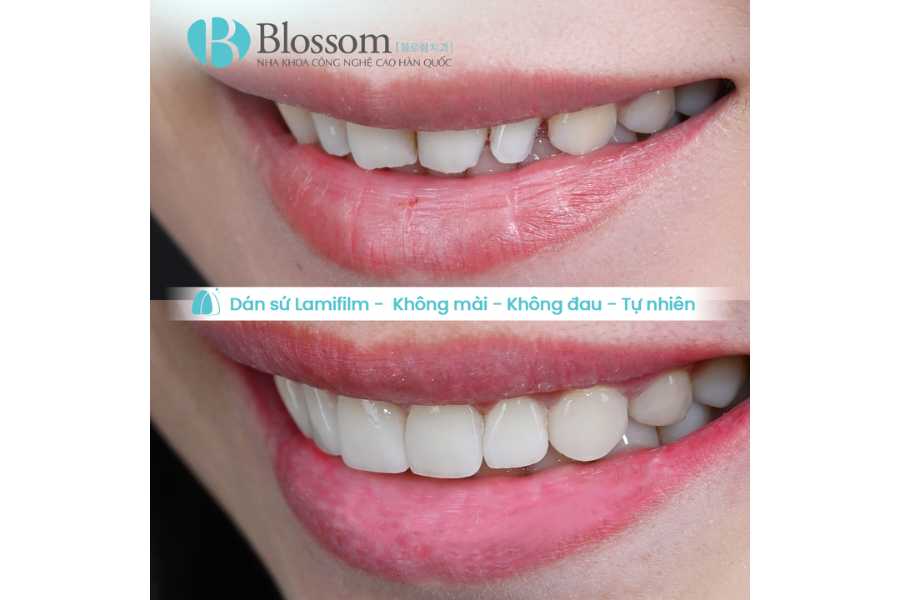 dan su khe thua khong mai rang 6