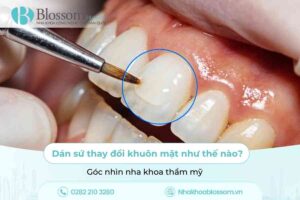 Dán sứ thay đổi khuôn mặt như thế nào? Góc nhìn nha khoa thẩm mỹ