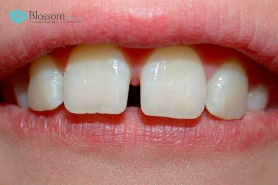 Răng cửa thưa: Nguyên nhân, tác hại và giải pháp khắc phục hiệu quả 1 rang cua thua 1