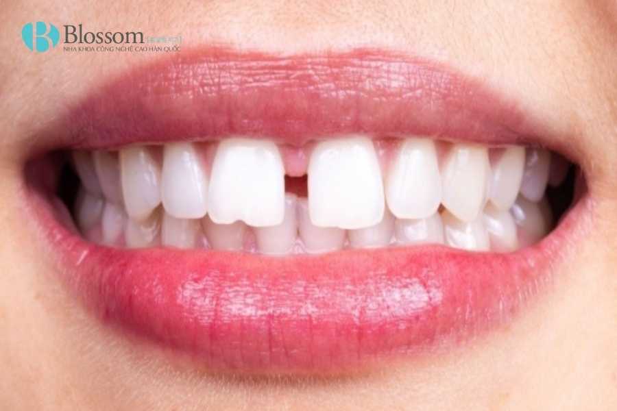 Răng cửa thưa: Nguyên nhân, tác hại và giải pháp khắc phục hiệu quả 2 rang cua thua 2