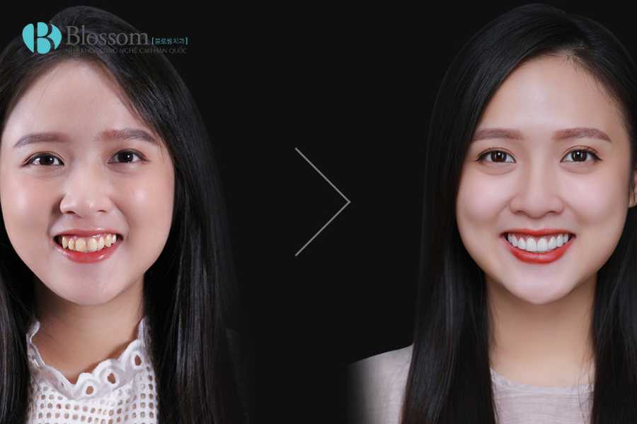 Ưu điểm của dán sứ không mài Lamifilm: Giải pháp thẩm mỹ bảo tồn răng tối ưu nhất hiện nay 3 uu diem cua dan su khong mai lamifilm 3