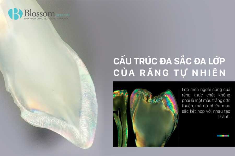 Ưu điểm của dán sứ không mài Lamifilm: Giải pháp thẩm mỹ bảo tồn răng tối ưu nhất hiện nay 5 uu diem cua dan su khong mai lamifilm 5