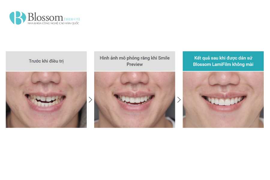 Ưu điểm của dán sứ không mài Lamifilm: Giải pháp thẩm mỹ bảo tồn răng tối ưu nhất hiện nay 6 uu diem cua dan su khong mai lamifilm 6