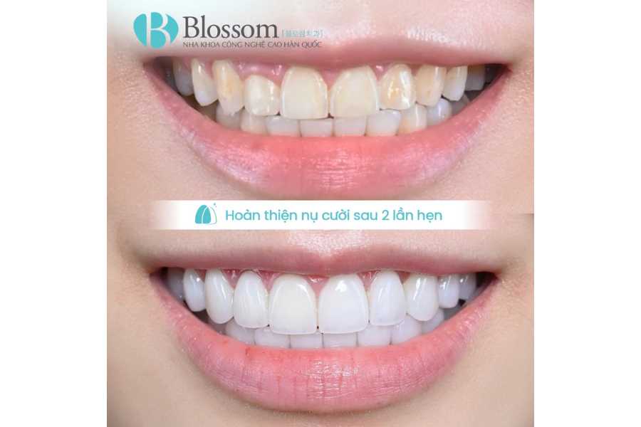 Ưu điểm của dán sứ không mài Lamifilm: Giải pháp thẩm mỹ bảo tồn răng tối ưu nhất hiện nay 7 uu diem cua dan su khong mai lamifilm 7