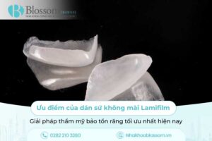 Ưu điểm của dán sứ không mài Lamifilm: Giải pháp thẩm mỹ bảo tồn răng tối ưu nhất hiện nay