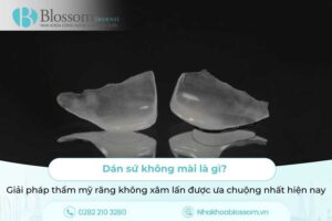 Dán sứ không mài là gì? Giải pháp thẩm mỹ răng không xâm lấn được ưa chuộng nhất hiện nay