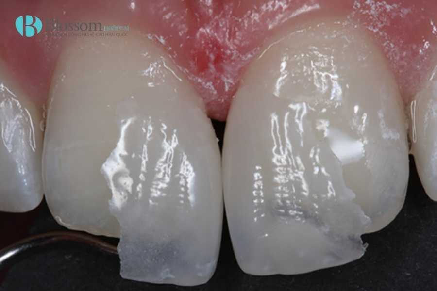 Dán sứ không mài là gì? Giải pháp thẩm mỹ răng không xâm lấn được ưa chuộng nhất hiện nay 2 Dan su khong mai la gi 2