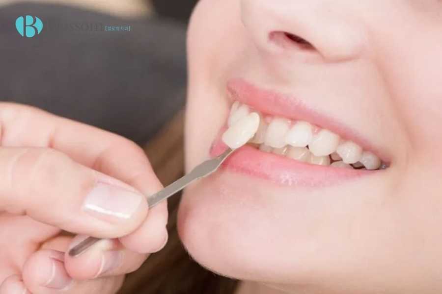 Dán sứ không mài là gì? Giải pháp thẩm mỹ răng không xâm lấn được ưa chuộng nhất hiện nay 3 Dan su khong mai la gi 3