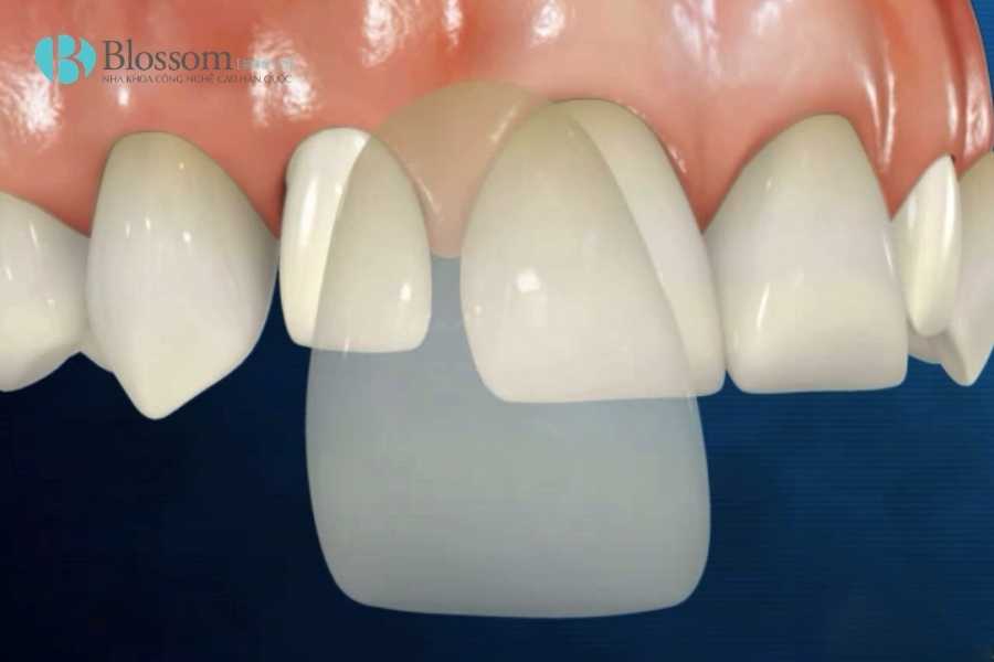 Dán sứ không mài là gì? Giải pháp thẩm mỹ răng không xâm lấn được ưa chuộng nhất hiện nay 4 Dan su khong mai la gi 4