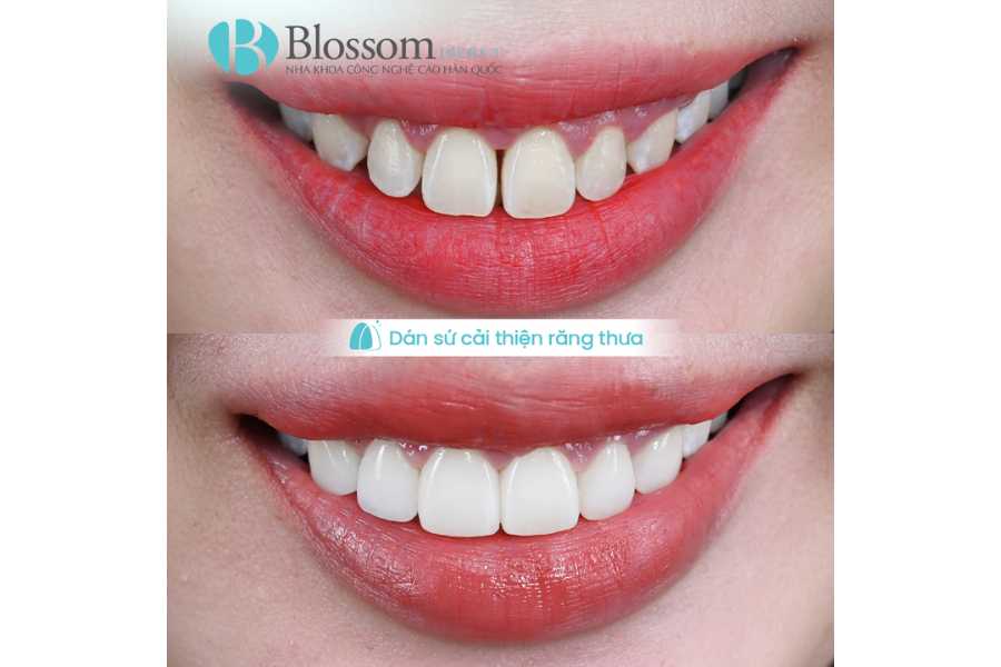 Dán sứ không mài là gì? Giải pháp thẩm mỹ răng không xâm lấn được ưa chuộng nhất hiện nay 5 Dan su khong mai la gi 5