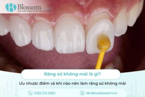 Răng sứ không mài là gì? Ưu nhược điểm và khi nào nên làm răng sứ không mài