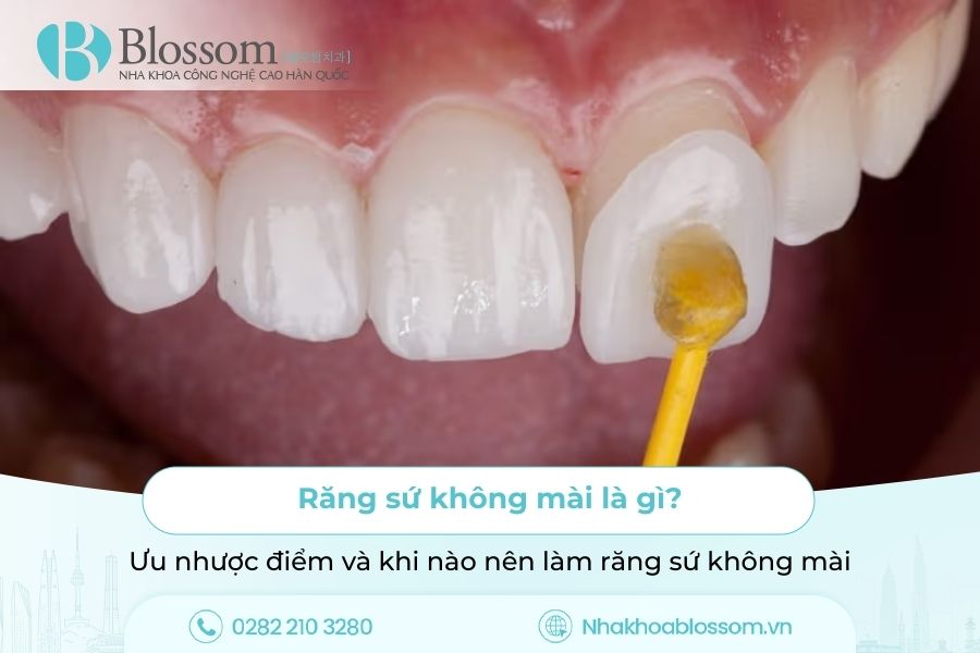 Răng sứ không mài là gì? Ưu nhược điểm và khi nào nên làm răng sứ không mài