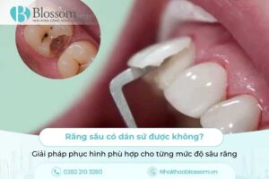 Răng sâu có dán sứ được không? Giải pháp phục hình phù hợp cho từng mức độ sâu răng