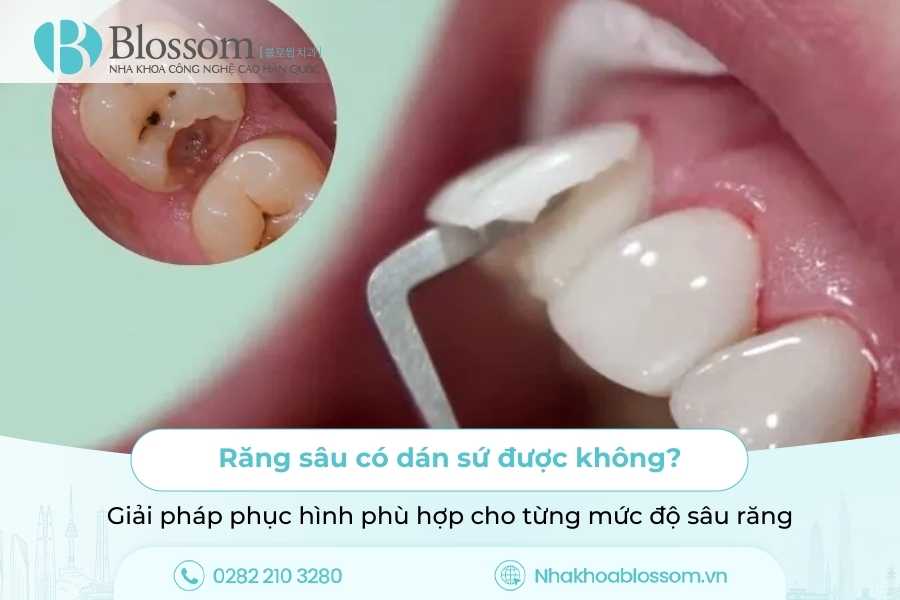 Răng sâu có dán sứ được không? Giải pháp phục hình phù hợp cho từng mức độ sâu răng