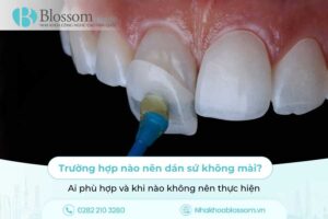 Trường hợp nào nên dán sứ không mài? Ai phù hợp và khi nào không nên thực hiện