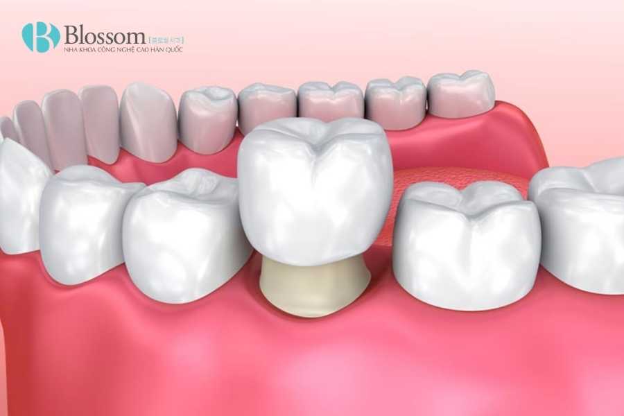 Bọc sứ bị hôi miệng: Nguyên nhân thật sự & cách khắc phục hiệu quả 1 boc su bi hoi mieng 1