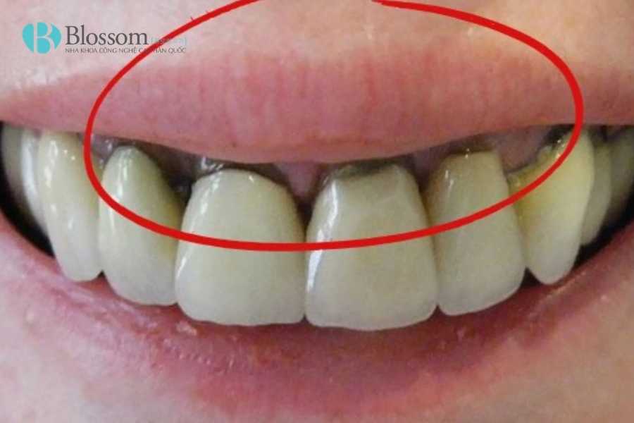 Bọc sứ bị hôi miệng: Nguyên nhân thật sự & cách khắc phục hiệu quả 2 boc su bi hoi mieng 2