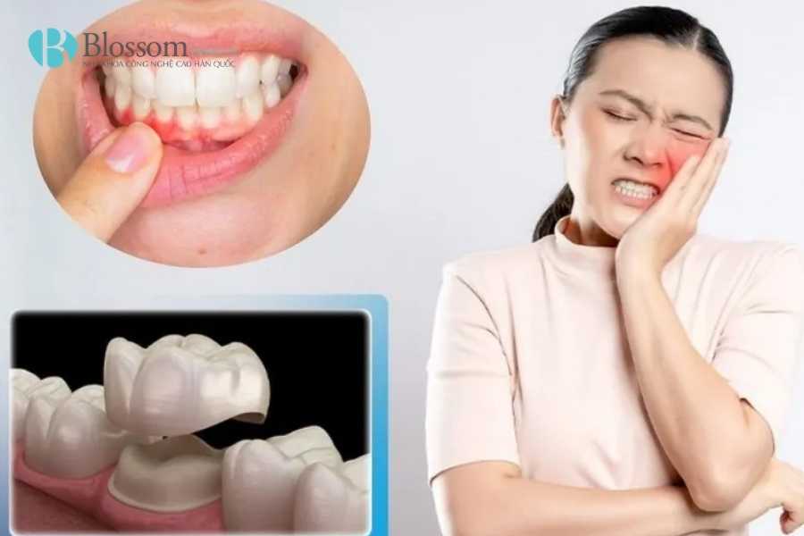 Bọc sứ bị hôi miệng: Nguyên nhân thật sự & cách khắc phục hiệu quả 3 boc su bi hoi mieng 3